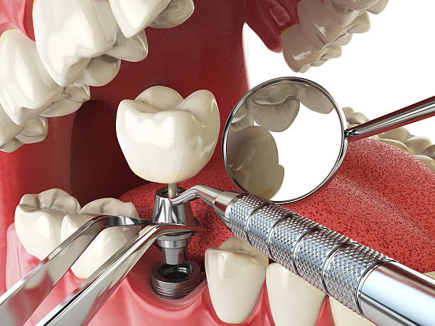 Best Emergency Dentist for Knocked-Out Tooth in Diboll, TX
